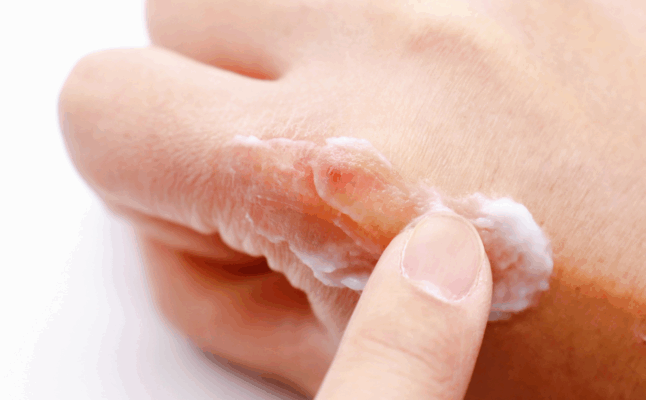 Nahaufnahme einer trockenen, rissigen und geröteten Hautstelle auf dem Handrücken, auf die gerade eine weiße Pflegecreme aufgetragen wird.