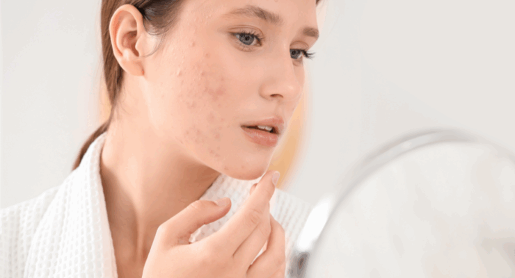 Frau mit unreiner Haut im Erwachsenenalter betrachtet Pickel und Rötungen im Gesicht beim Blick in den Spiegel.