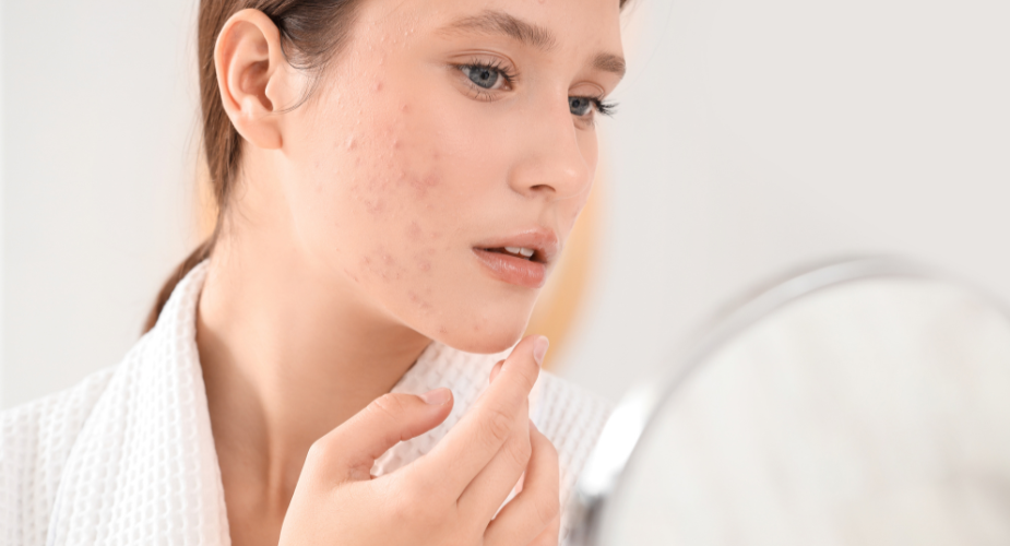 Frau mit unreiner Haut im Erwachsenenalter betrachtet Pickel und Rötungen im Gesicht beim Blick in den Spiegel.